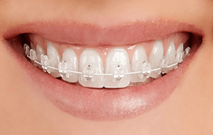 ارتودنسی ثابت با استفاده از براکت های همرنگ دندان
