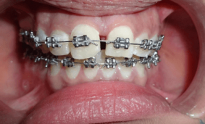 اصلاح ناهنجاری های دندان ها