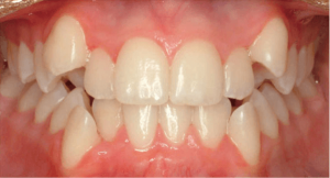 دندان های بیرون زده