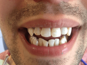انواع ناهنجاری های دندان