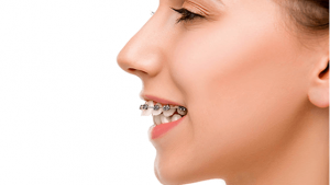 درمان دندان های بیرون زده توسط متخصص ارتودنسی