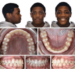 تأثیر تقاطع دندان های خلفی بر سلامت دهان