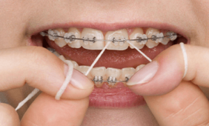 مناسب ترین نخ دندان در طول ارتودنسی