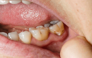 عوامل مخاطره آمیز تقاطع دندان های خلفی