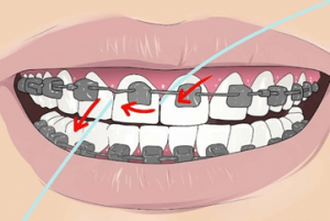 طرز استفاده از نخ دندان در طول ارتودنسی