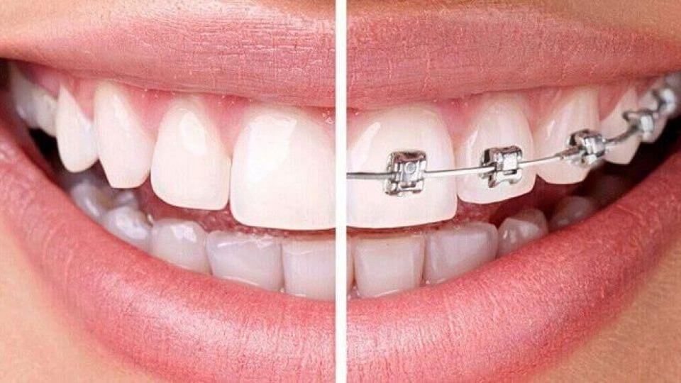 Fixed orthodontics ارتودنسی ثابت