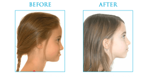 Correction of jaw growth and treatment of jaw problems