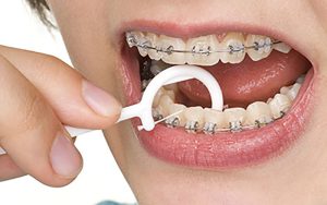 Oral hygiene in dental floss orthodontics
