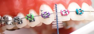 Oral hygiene in orthodontic brushing