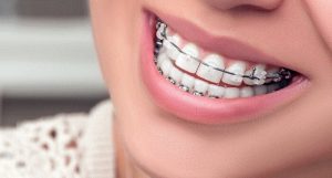 Oral hygiene in orthodontic