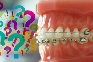 Oral hygiene in orthodontic