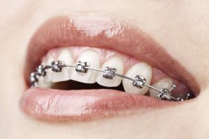 Oral hygiene in orthodontic