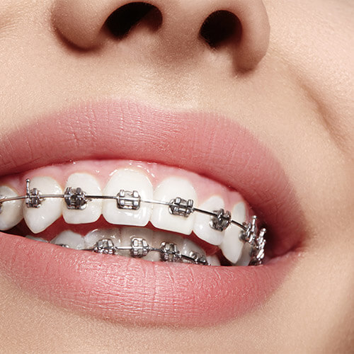 Oral hygiene in orthodontic