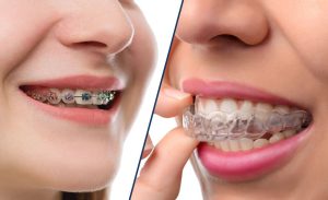 type of Orthodontics with removable plate