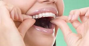 Orthodontics with removable plate