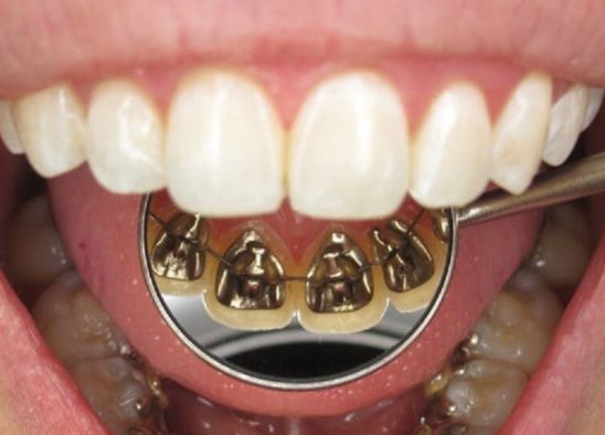 lingual Braces orthodontics