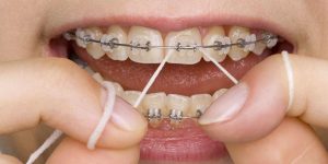 Oral hygiene in dental floss orthodontics