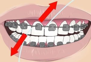 The correct method of flossing in orthodontics