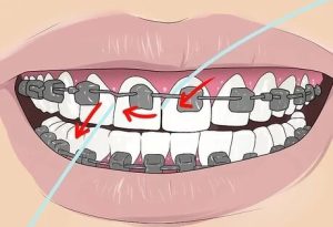 The correct method of flossing in orthodontics