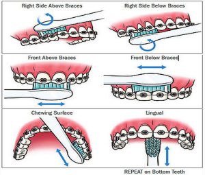 Oral hygiene in orthodontic brushing
