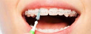 Oral hygiene in orthodontic brushing