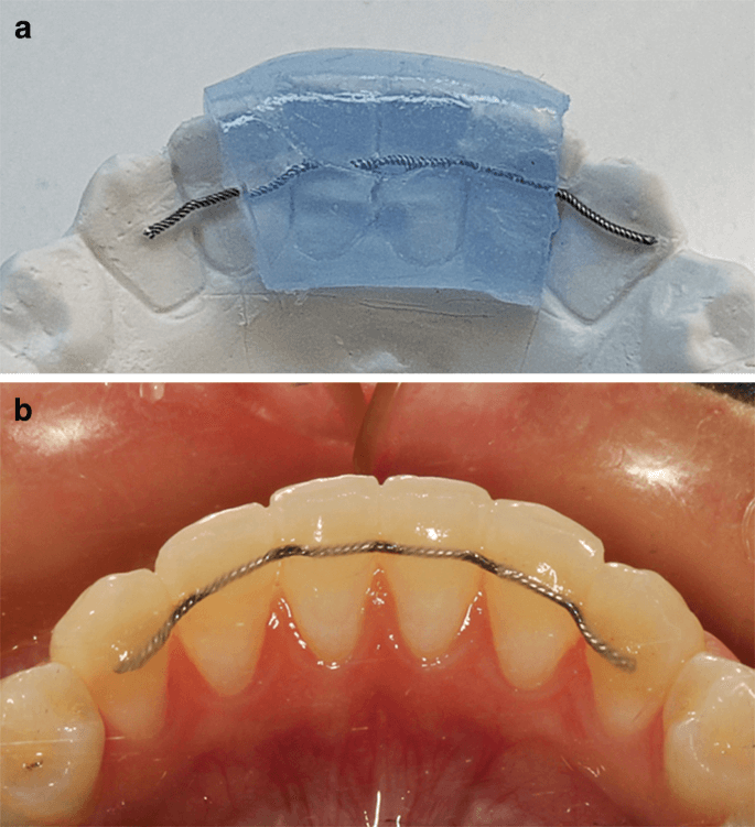 fixed & Bonded retainer