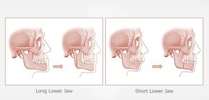 Corrective Jaw abnormalities