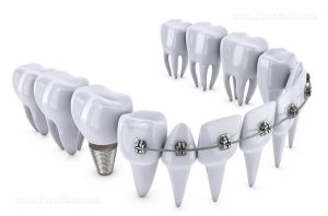 Do orthodontics and implants together