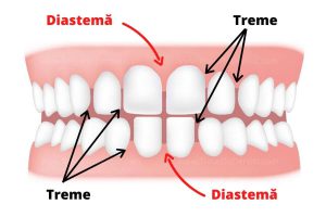 Excessive Spacing teeth