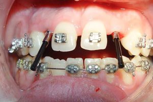 Implant implantation