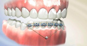 Implants in orthodontics-temp-anchorage-device