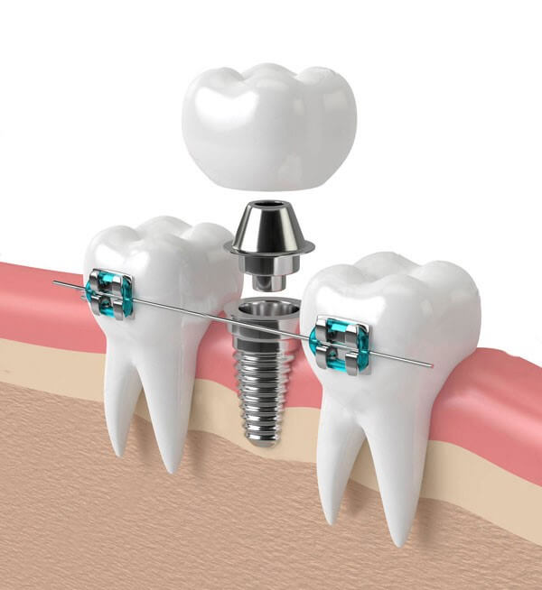 Implants in orthodontics
