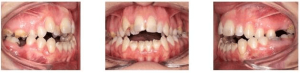 Increased caries in the shedding teeth