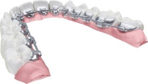 Lingual braces Orthodontic