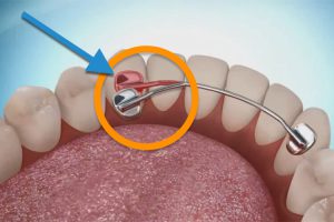 fixed & Bonded retainer