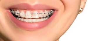 Orthodontic treatment