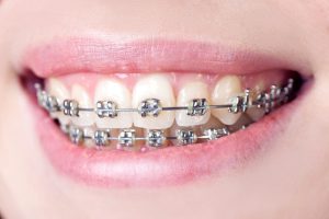 Orthodontics with metal braces Invisalign