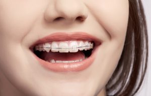 Orthodontics with ceramic braces
