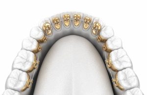Orthodontics with lingual braces