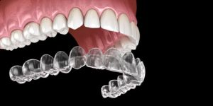  Aligners Night Guard essix retainer mouth guard