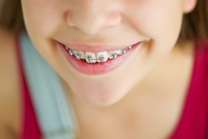 Orthodontic for children with braces