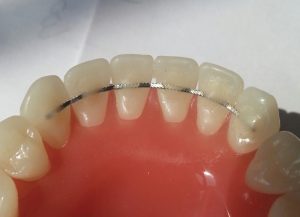 fixed & Bonded retainer