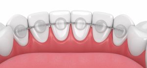 fixed & Bonded retainer