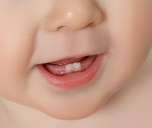 Tooth eruption in children