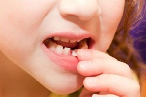 Tooth eruption in children