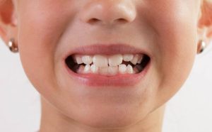 Tooth eruption in children