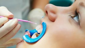 Topical use of fluoride