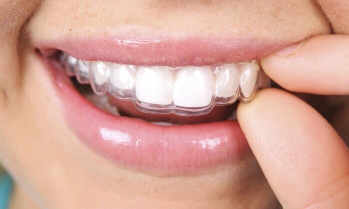 Aligners Night Guard essix retainer mouth guard