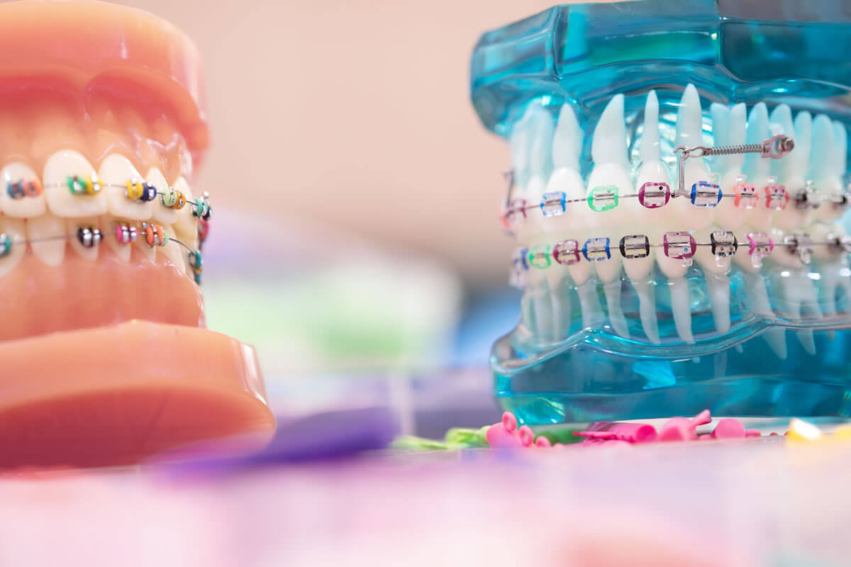 Why do we need orthodontics-options