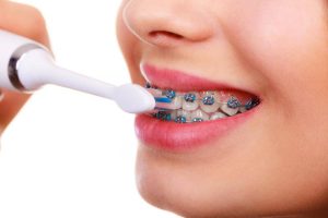 How to take care of your teeth & braces during orthodontics